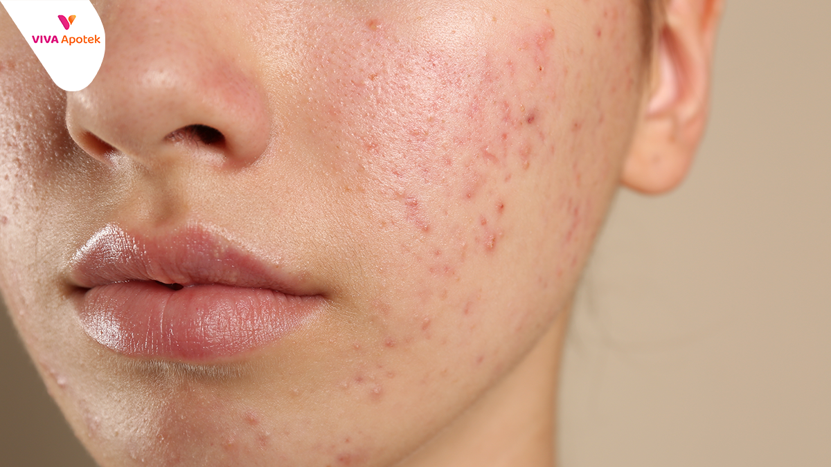 kenapa muka bruntusan